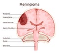 Meningioma. Brain tumor that forms from the meninges, the membranous Royalty Free Stock Photo