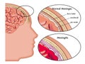 Meningitis