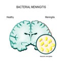 Meningitis. Human brain and meningococcal bacteria.