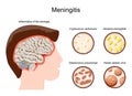 Meningitis. Human`s brain with Inflammation of the meninges and Pathogens