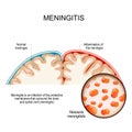 Meningitis. brain with Normal meninges and Inflammation of