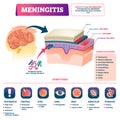 Meningitis vector illustration. Labeled brain membrane inflammation scheme. Royalty Free Stock Photo