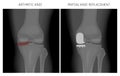 Meniscus _Arthritic knee and Partial knee replacement Royalty Free Stock Photo