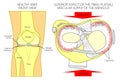 Meniscus _Blood supply_Superior view