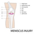 Meniscus knee injury