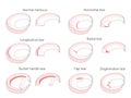 Meniscus _Tear types