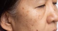 Menopausal women worry about melasma on face Royalty Free Stock Photo