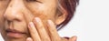 Menopausal women worry about melasma on face