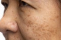 Menopausal women worry about melasma on face