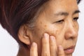 Menopausal women worry about melasma on face