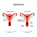 Menopause or climacteric. Younger and older women uterus