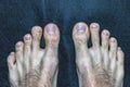 Mens feet with scuffs and calluses on the fingers. callused and dirty foots of a man with long and dirty finger nails