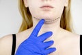 Mentoplasty: plastic chin. Patient before chin and neck surgery. Plastic surgeon advises Royalty Free Stock Photo