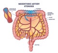Mesenteric artery stenosis as blockage in blood vessel outline diagram