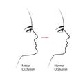 Mesial bite profile before and after orthodontic treatment. Human with malocclusion, lower jaw extended forward, bite