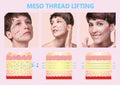 Meso thread Lift. Young female with clean fresh skin. Beautiful woman. face and neck. Royalty Free Stock Photo