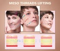 Meso thread Lift. Young female with clean fresh skin. Beautiful woman. face and neck.