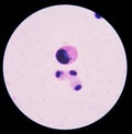 Mesothelial cells in body fluid.