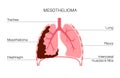 Mesothelioma cancer disease