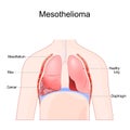 mesothelioma. Malignant tumor of lung Royalty Free Stock Photo