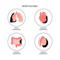 Mesothelioma tumor types Royalty Free Stock Photo