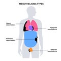 Mesothelioma tumor types Royalty Free Stock Photo