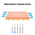 Mesotherapy Threads Lifting. Different types of threads for facelift. The structure of the skin. Wrinkles. Infographics