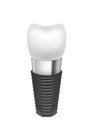 Metal assembled tooth implant