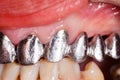 Metal Basis Dental Bridge