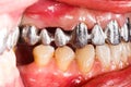 Metal Basis Dental Bridge Royalty Free Stock Photo