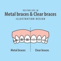 Metal braces teeth & Clear braces teeth Upper comparison illustration vector on blue background. Dental concept