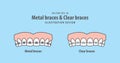 Metal braces teeth & Clear braces teeth Upper illustration vector on blue background. Dental concept