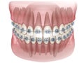 Metal braces and transparent dental model. Medically accurate 3D illustration