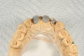 Metal cast pin of a human tooth on a gypsum model close-up in a dental laboratory. Orthopedic dentistry preparation for crown Royalty Free Stock Photo