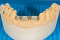 Metal cast pin of a human tooth on a gypsum model close-up in a dental laboratory. Orthopedic dentistry preparation for crown Royalty Free Stock Photo