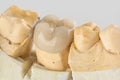 Metal ceramic dental crown photographed close-up Royalty Free Stock Photo