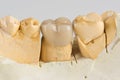 Metal ceramic dental crown photographed close-up Royalty Free Stock Photo