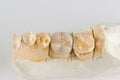 Metal ceramic dental crown photographed close-up Royalty Free Stock Photo