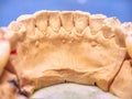 Metal-ceramic dental crown is tried on an gypsum model Royalty Free Stock Photo