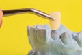 A metal-ceramic dental crown in tweezers against a plaster dental jaw and a yellow background. Final production of