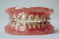 metal dental bracers on a model of human theeth Royalty Free Stock Photo