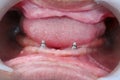 Metal tooth root implants