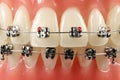Metal wired dental braces Royalty Free Stock Photo