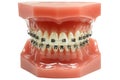 Metal wired dental braces Royalty Free Stock Photo