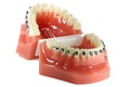 Metal wired dental braces Royalty Free Stock Photo
