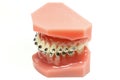 Metal wired dental braces Royalty Free Stock Photo