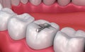 Metall dental fillings, Medically accurate