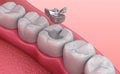 Metall dental fillings, Medically accurate illustration