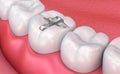 Metall dental fillings, Medically accurate illustration