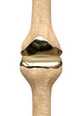 Metallic knee prosthesis replacing bone structures worn by osteoporosis or a sports accident